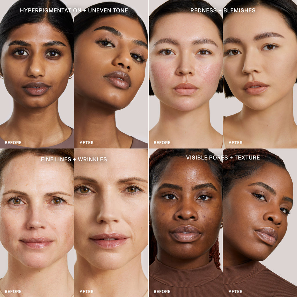 Four sets of before and after portraits demonstrating the effectiveness of skincare treatments on various skin concerns.