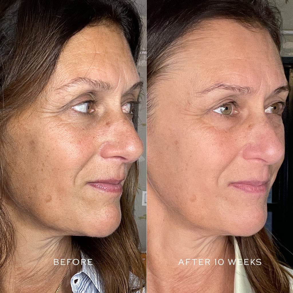 Side-by-side photos of a woman's profile showing skin improvements in hyperpigmentation before and after 10 weeks of treatment with Westman Atelier Suprême C serum.