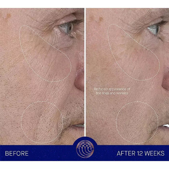 Comparison of skin appearance before treatment and after 12 weeks, showing reduced fine lines and wrinkles.