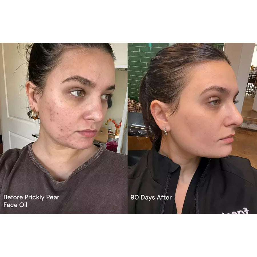 Before and after comparison of a woman's skin, 90 days apart, showing the effects of using prickly pear face oil.