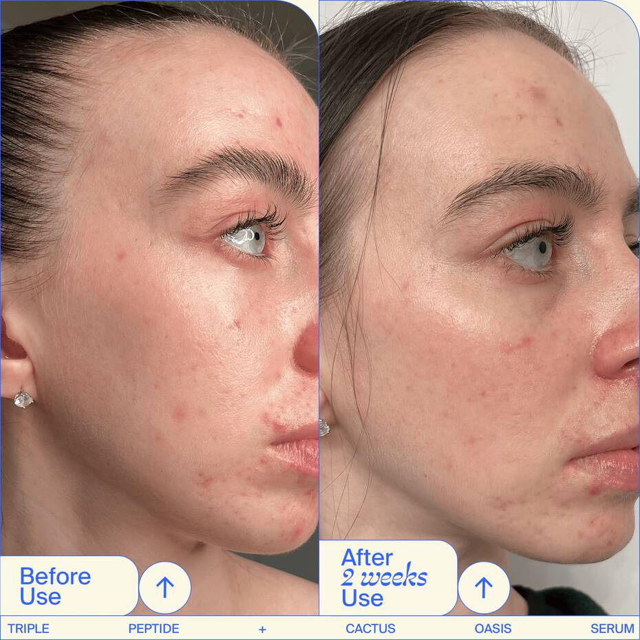 Before and after comparison of a person's skin condition following two weeks of a skincare product regimen.