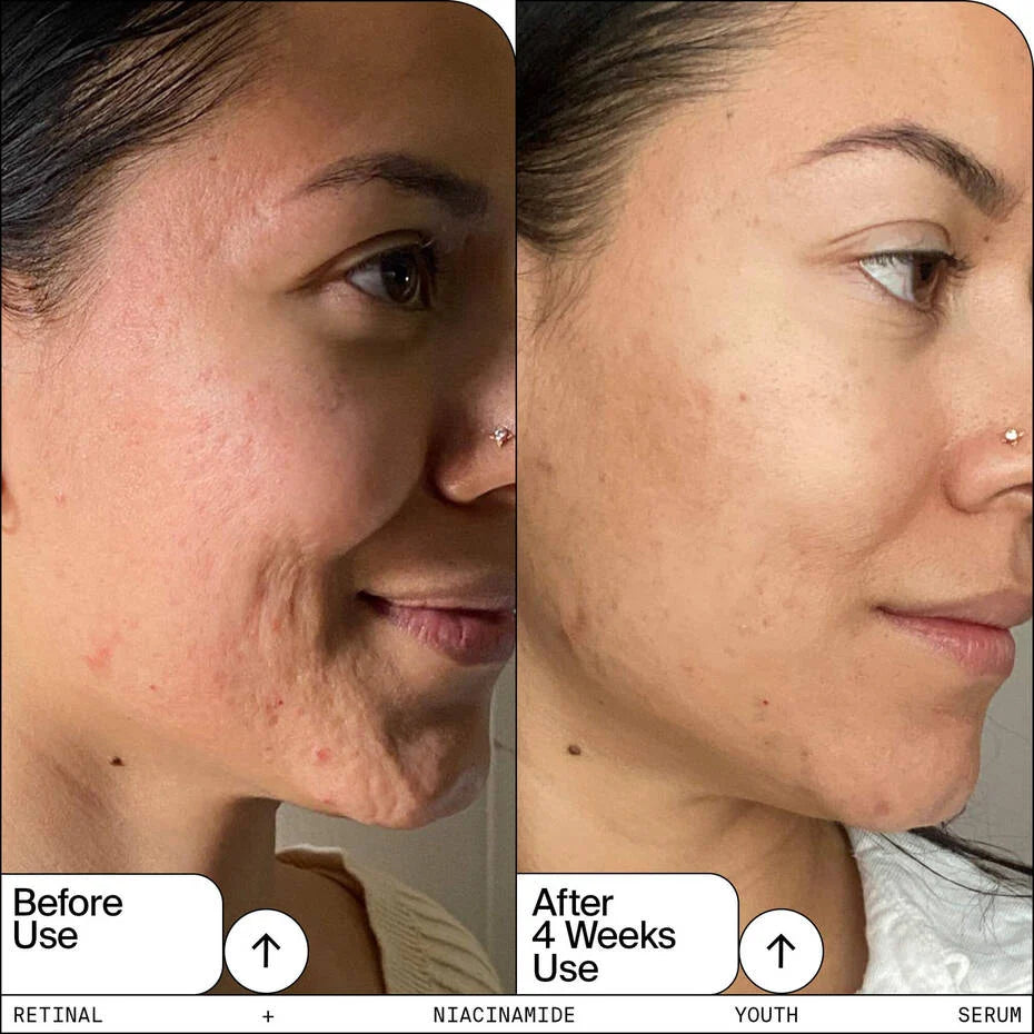 Comparison of skin condition before and after 4 weeks of using retinal and niacinamide serum.